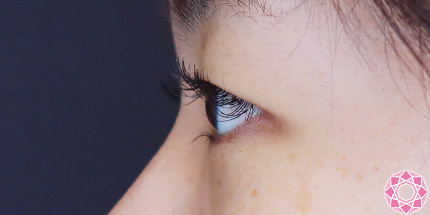 年代：20代 施術名：二重埋没法 施術前｜【公式】東京形成美容外科