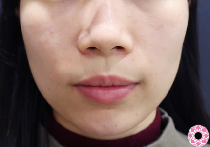 年代：20代 施術名：アゴのヒアルロン酸注入 施術後｜【公式】東京形成美容外科