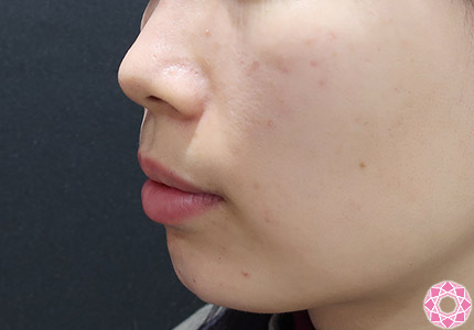 年代：20代 施術名：アゴのヒアルロン酸注入 施術後｜【公式】東京形成美容外科