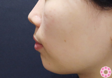年代：20代 施術名：アゴのヒアルロン酸注入 施術後｜【公式】東京形成美容外科