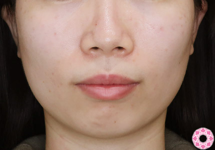年代：20代 施術名：アゴのヒアルロン酸注入 施術前｜【公式】東京形成美容外科