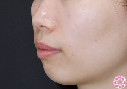 年代：20代 施術名：アゴのヒアルロン酸注入 施術前｜【公式】東京形成美容外科