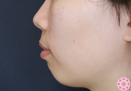 年代：20代 施術名：アゴのヒアルロン酸注入 施術前｜【公式】東京形成美容外科