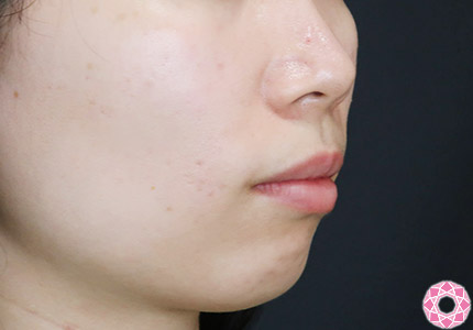 年代：20代 施術名：アゴのヒアルロン酸注入 施術前｜【公式】東京形成美容外科