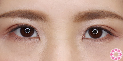 年代：20代 施術名：二重埋没法 施術後｜【公式】東京形成美容外科