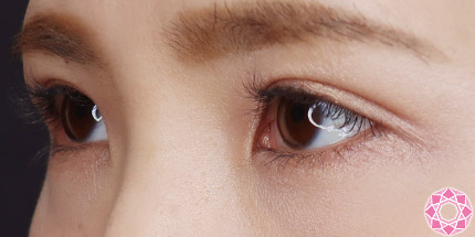 年代：20代 施術名：二重埋没法 施術後｜【公式】東京形成美容外科