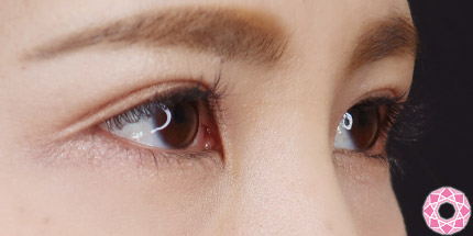 年代：20代 施術名：二重埋没法 施術後｜【公式】東京形成美容外科