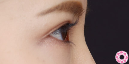 年代：20代 施術名：二重埋没法 施術後｜【公式】東京形成美容外科