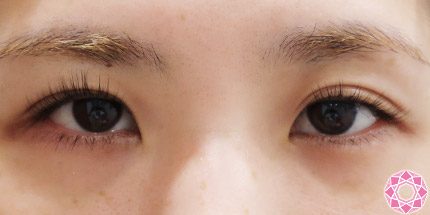 年代：20代 施術名：二重埋没法 施術前｜【公式】東京形成美容外科