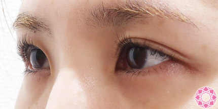 年代：20代 施術名：二重埋没法 施術前｜【公式】東京形成美容外科