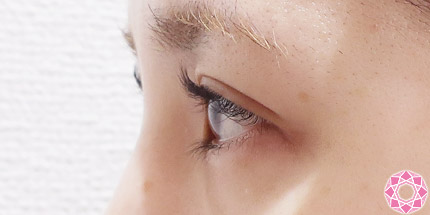 年代：20代 施術名：二重埋没法 施術前｜【公式】東京形成美容外科