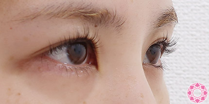 年代：20代 施術名：二重埋没法 施術前｜【公式】東京形成美容外科