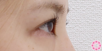 年代：20代 施術名：二重埋没法 施術前｜【公式】東京形成美容外科