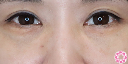 年代：40代 施術名：目の下のふくらみ取り 施術後｜【公式】東京形成美容外科