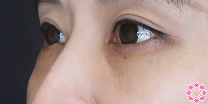 年代：40代 施術名：目の下のふくらみ取り 施術後｜【公式】東京形成美容外科