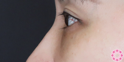 年代：40代 施術名：目の下のふくらみ取り 施術後｜【公式】東京形成美容外科