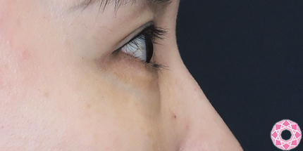 年代：40代 施術名：目の下のふくらみ取り 施術後｜【公式】東京形成美容外科