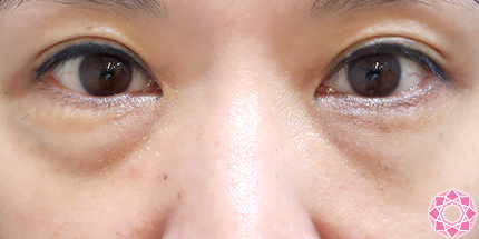 年代：40代 施術名：目の下のふくらみ取り 施術前｜【公式】東京形成美容外科