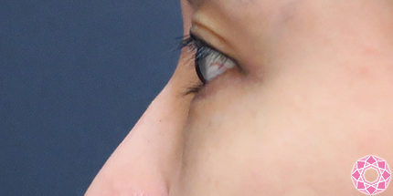 年代：40代 施術名：目の下のふくらみ取り 施術前｜【公式】東京形成美容外科