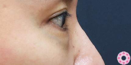 年代：40代 施術名：目の下のふくらみ取り 施術前｜【公式】東京形成美容外科