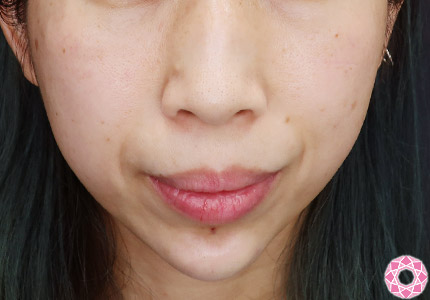 年代：40代 施術名：アゴのヒアルロン酸注入 施術後｜【公式】東京形成美容外科