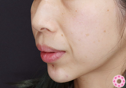 年代：40代 施術名：アゴのヒアルロン酸注入 施術後｜【公式】東京形成美容外科