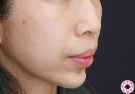 年代：40代 施術名：アゴのヒアルロン酸注入 施術後｜【公式】東京形成美容外科