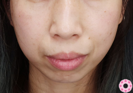 年代：40代 施術名：アゴのヒアルロン酸注入 施術前｜【公式】東京形成美容外科