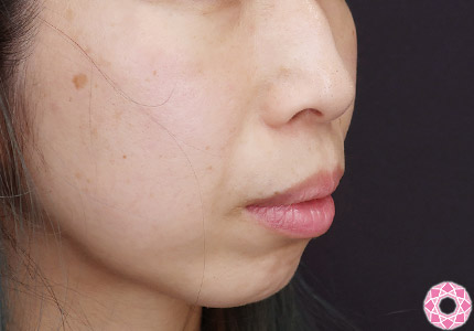 年代：40代 施術名：アゴのヒアルロン酸注入 施術前｜【公式】東京形成美容外科