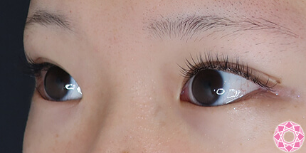 年代：10代 施術名：二重埋没法 施術後｜【公式】東京形成美容外科