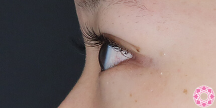 年代：10代 施術名：二重埋没法 施術後｜【公式】東京形成美容外科