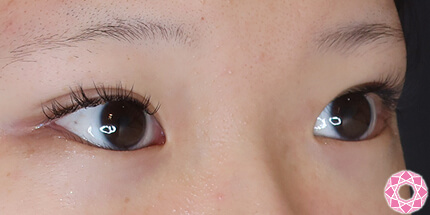 年代：10代 施術名：二重埋没法 施術後｜【公式】東京形成美容外科