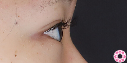 年代：10代 施術名：二重埋没法 施術後｜【公式】東京形成美容外科