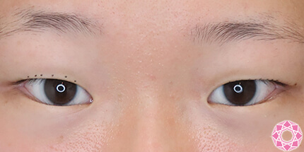 年代：10代 施術名：二重埋没法 施術前｜【公式】東京形成美容外科