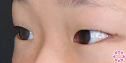 年代：10代 施術名：二重埋没法 施術前｜【公式】東京形成美容外科