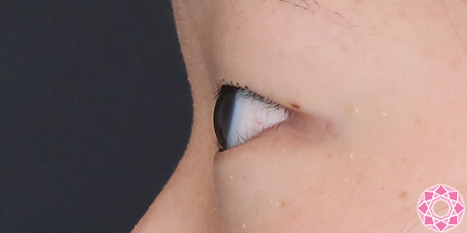 年代：10代 施術名：二重埋没法 施術前｜【公式】東京形成美容外科