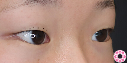 年代：10代 施術名：二重埋没法 施術前｜【公式】東京形成美容外科