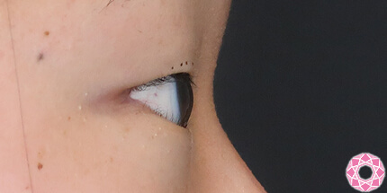 年代：10代 施術名：二重埋没法 施術前｜【公式】東京形成美容外科