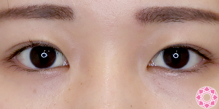 年代：20代 施術名：二重埋没法 施術後｜【公式】東京形成美容外科