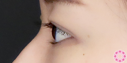 年代：20代 施術名：二重埋没法 施術後｜【公式】東京形成美容外科