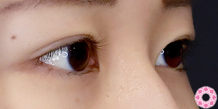 年代：20代 施術名：二重埋没法 施術後｜【公式】東京形成美容外科