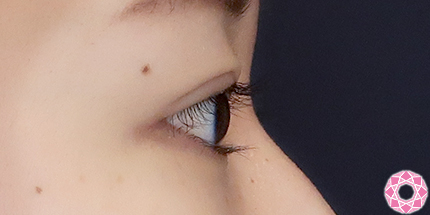 年代：20代 施術名：二重埋没法 施術後｜【公式】東京形成美容外科