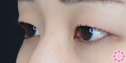 年代：20代 施術名：二重埋没法 施術前｜【公式】東京形成美容外科