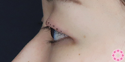 年代：20代 施術名：二重埋没法 施術前｜【公式】東京形成美容外科