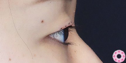 年代：20代 施術名：二重埋没法 施術前｜【公式】東京形成美容外科