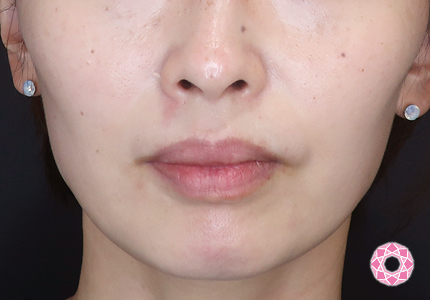 年代：30代 施術名：エラ取り（ボトックス） 施術後｜【公式】東京形成美容外科