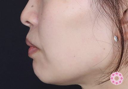 年代：30代 施術名：エラ取り（ボトックス） 施術後｜【公式】東京形成美容外科