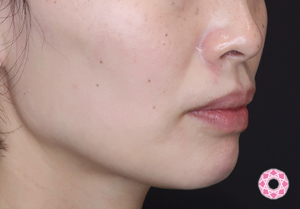 年代：30代 施術名：エラ取り（ボトックス） 施術後｜【公式】東京形成美容外科