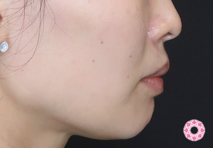 年代：30代 施術名：エラ取り（ボトックス） 施術後｜【公式】東京形成美容外科