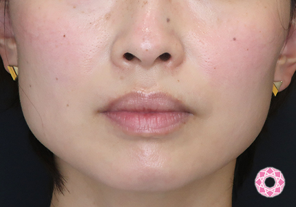 年代：30代 施術名：エラ取り（ボトックス） 施術前｜【公式】東京形成美容外科